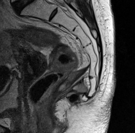 МРТ крестцово-копчикового отдела позвоночника