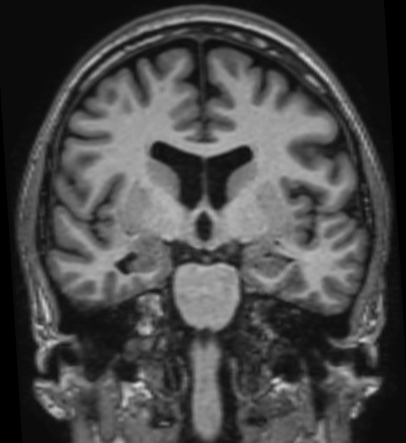 МРТ гиппокампов