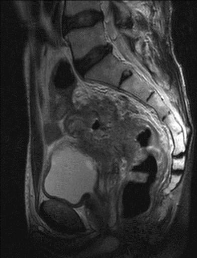 МРТ органов малого таза (муж) и наружных половых органов
