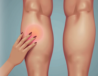 Перевязка перфорантных вен