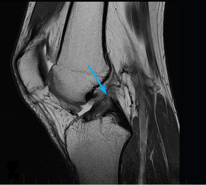 МРТ коленного сустава