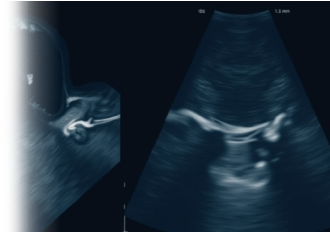 УЗИ щитовидной железы