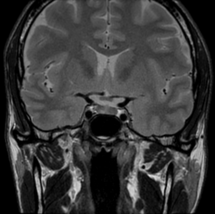 МРТ гипофиза