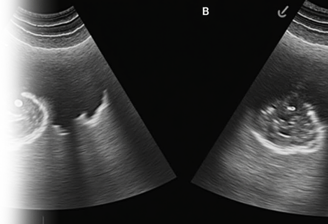 УЗИ плевральной области