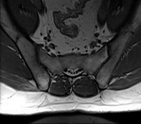 МРТ крестцово-подвздошных сочленений с контрастом
