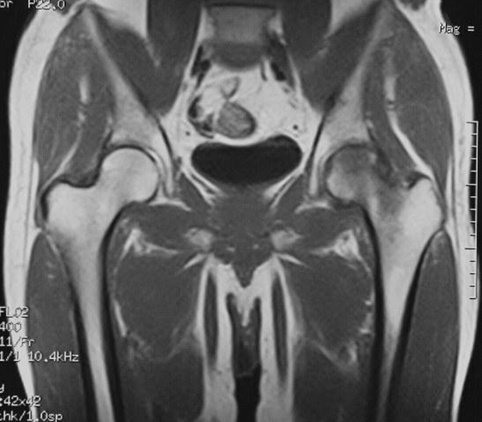 МРТ тазобедренных суставов