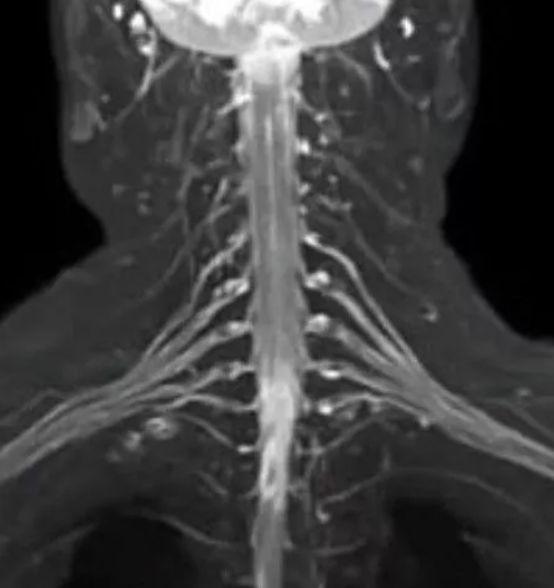 МРТ плечевого сустава