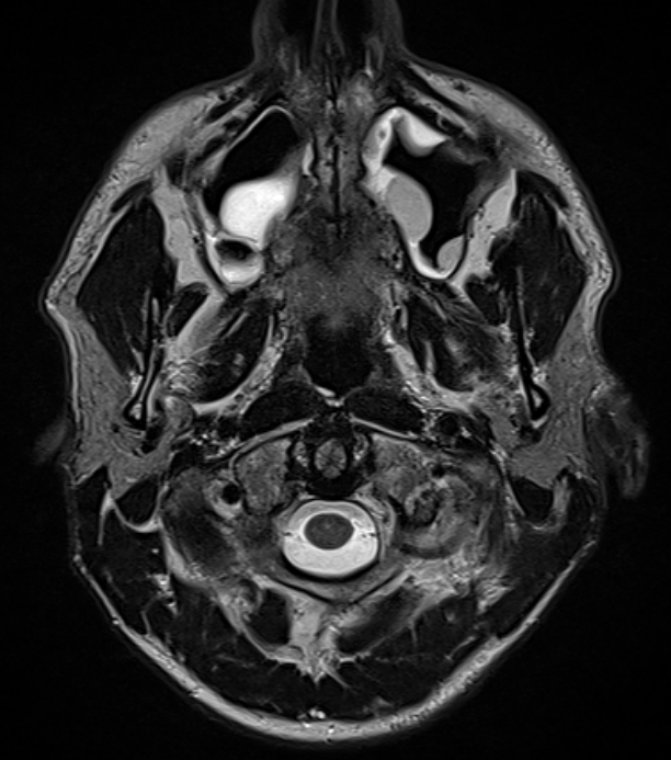 МРТ придаточных пазух носа