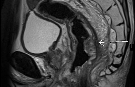 МР исследование прямой кишки и органов малого таза