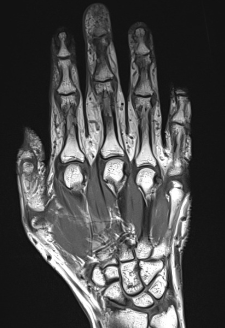 МРТ кисти