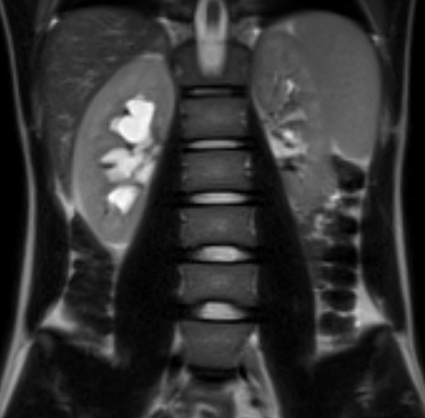 МРТ мочевыделительной системы