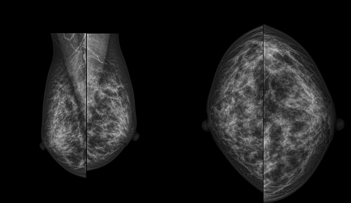 Маммография