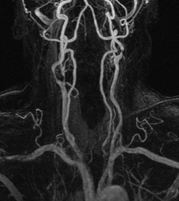 МР бесконтрастная ангиография сосудов шеи