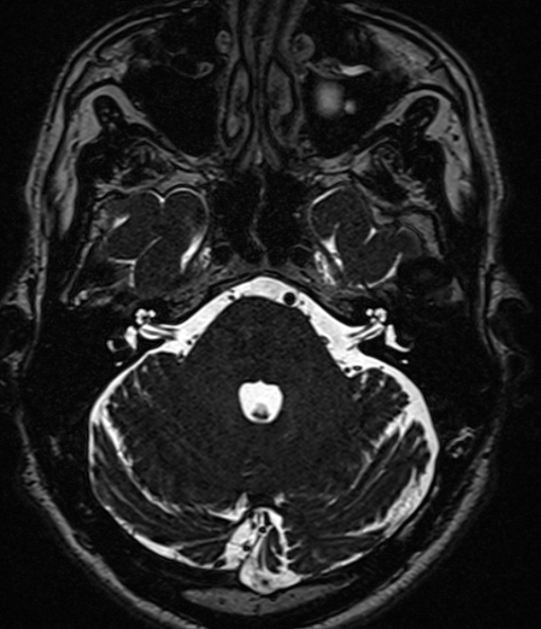 МРТ головного мозга при вазоневральном конфликте