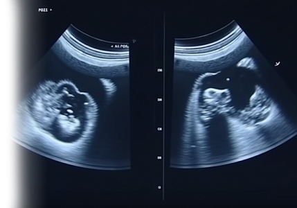 УЗИ молочных желез