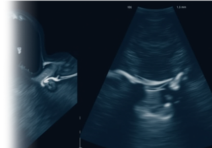 УЗИ щитовидной железы