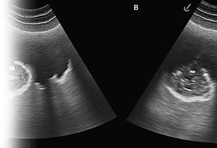 УЗИ плевральной области