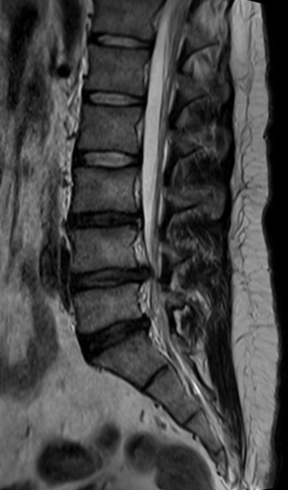 МРТ пояснично-крестцового отдела позвоночника