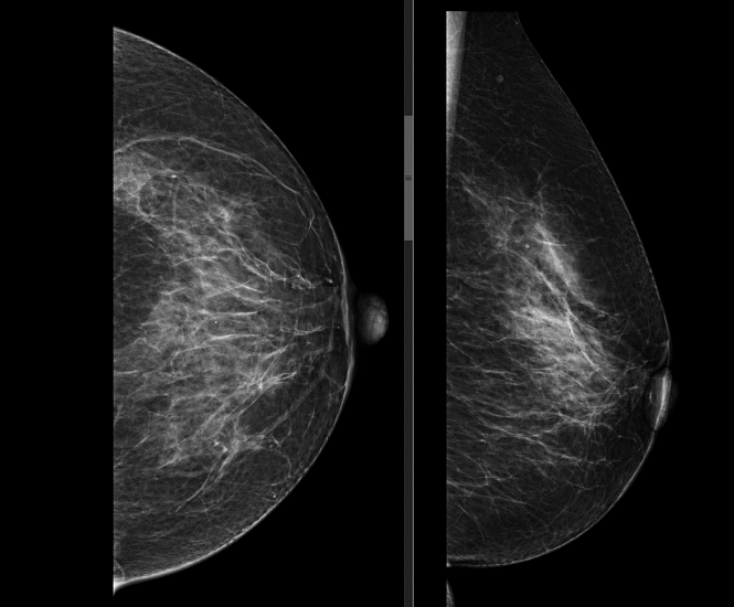 Маммография