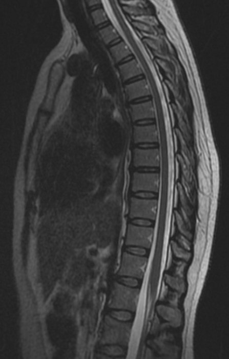 МРТ грудного отдела позвоночника